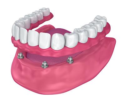 Diagram of overdentures in Vancouver