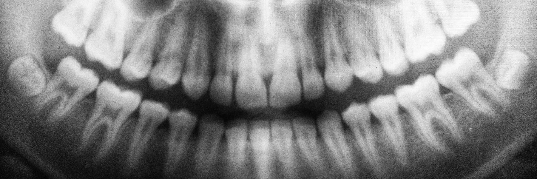 An x-ray of teeth