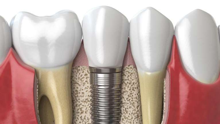 Image of a dental implant and it's screw inserted into the bone