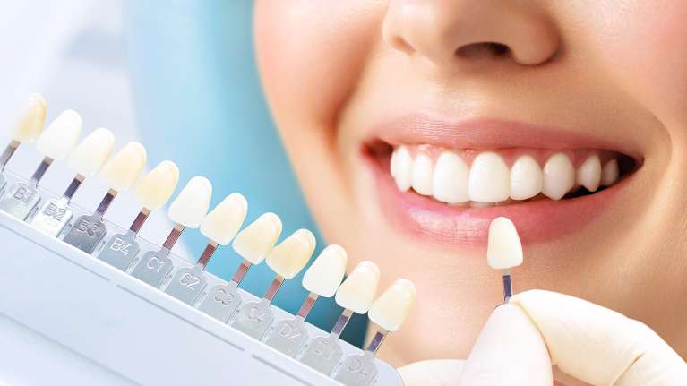 A woman comparing tooth shades | teeth whitening vancouver bc
