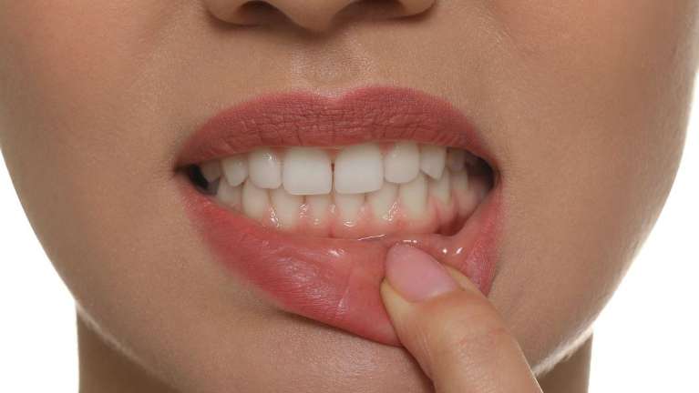 A woman showing her teeth | dental consultation Vancouver
