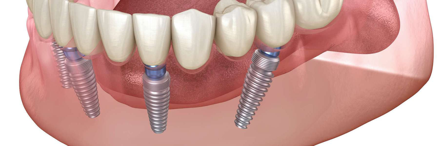all on x dental implants