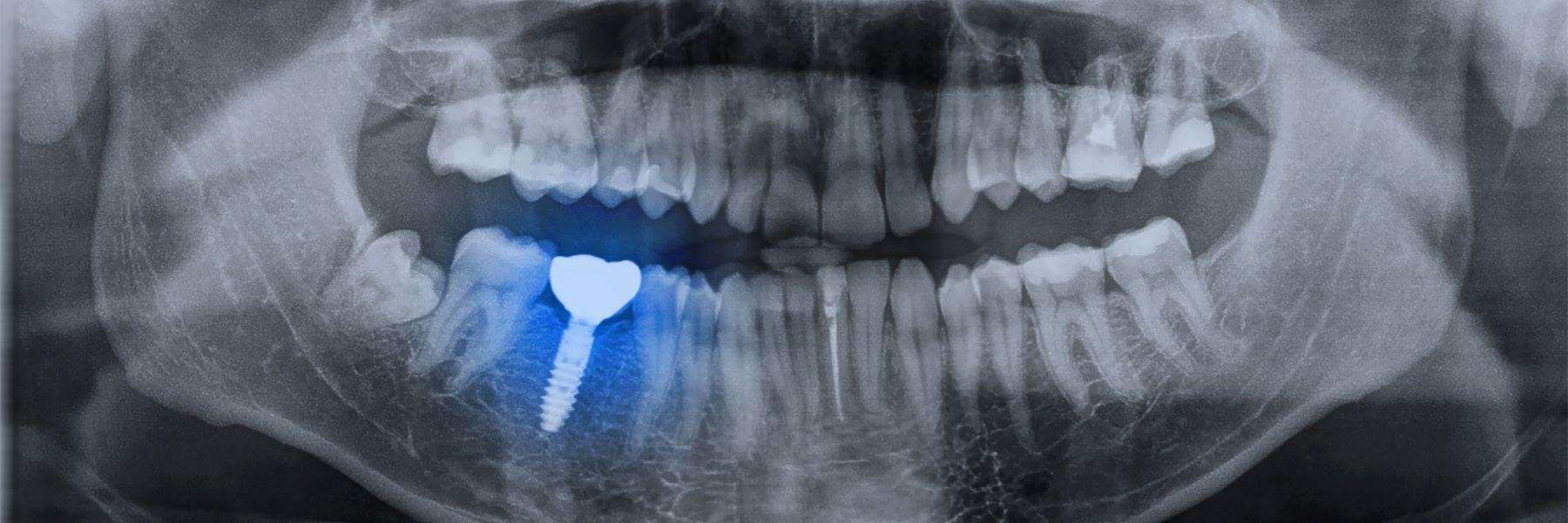 X-ray of a dental implant