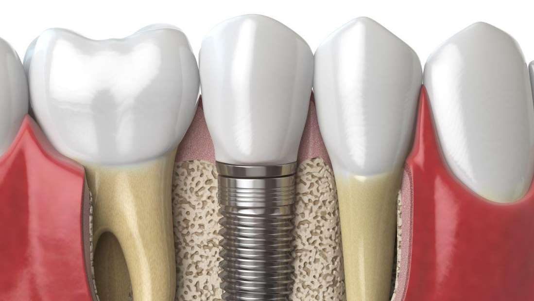 The History of Dental Implants Dental Implants Vancouver BC